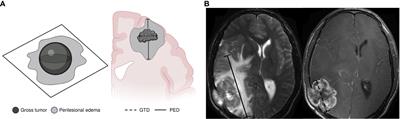 Perilesional edema diameter associated with brain metastases as a predictive factor of response to radiotherapy in non-small cell lung cancer